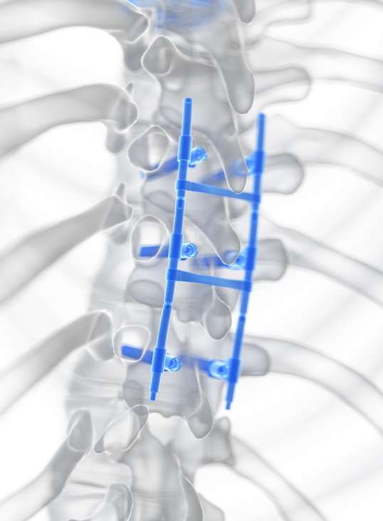 Stabilisierung durch ein Titankäfig-Implantat - Orthopädie in Düsseldorf